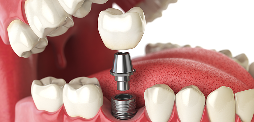 THE BASIC CONCEPT OF DENTAL IMPLANTS