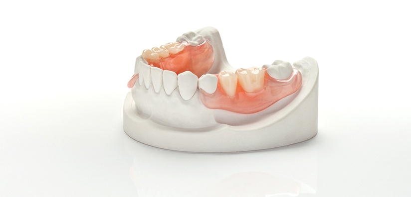DIY Partials(Teeth) : 7 Steps - Instructables