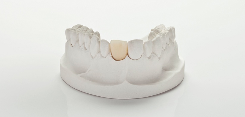 crown preparation lower anterior teeth