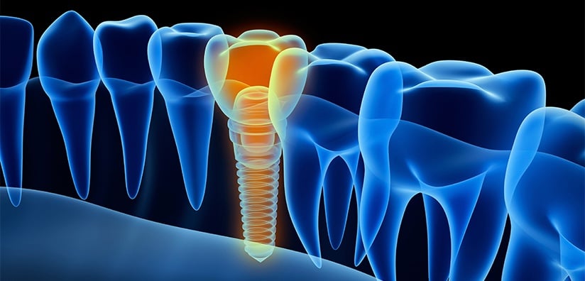 BENEFITS OF USING CT SCANS FOR DENTAL IMPLANTS