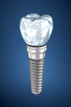 The Ultimate Guide To Dental Implants | Published