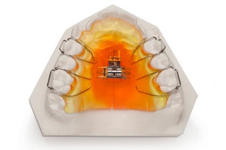 Orthodontics_Removable_Expansion_-3-Way_Expander